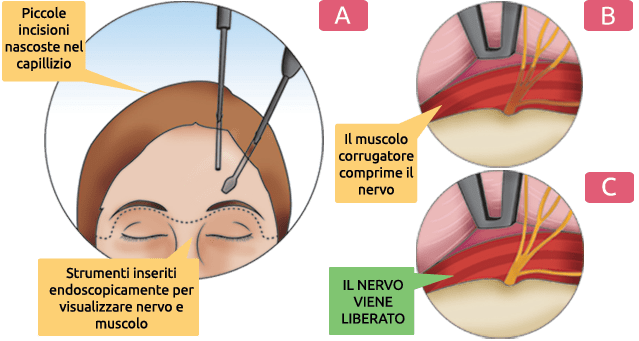 Chirurgia mini invasiva dei nervi sopra orbitali